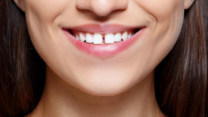 Диастема: Особенность или дефект?