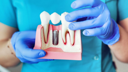 Что нужно знать об имплантатах?
