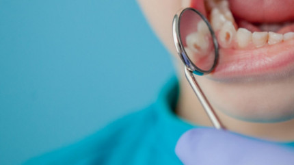 Острый кариес