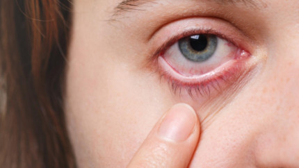 Небезпечне захворювання — кератит