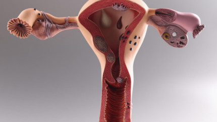 Що робити якщо Ваш діагноз - кіста яєчника?