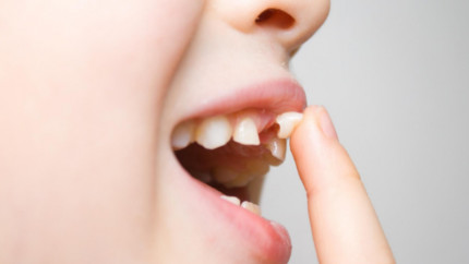 Что делать, если молочные зубы пришлось удалить, а до появления постоянных еще несколько лет?