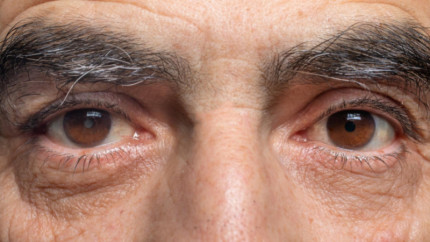 Чи може катаракта з‘явитися знову?