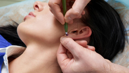 Что исправит отопластика