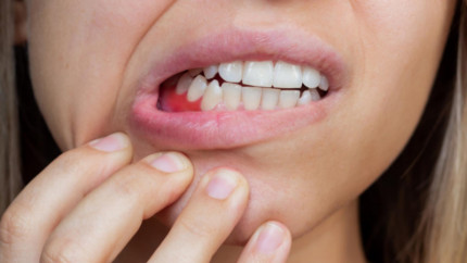 Всё о Пародонтите