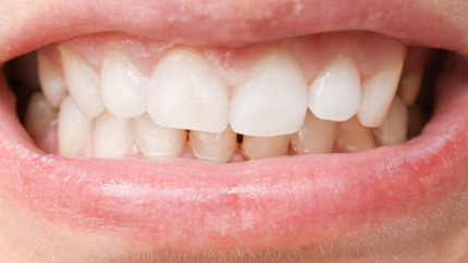 Перекрестный прикус