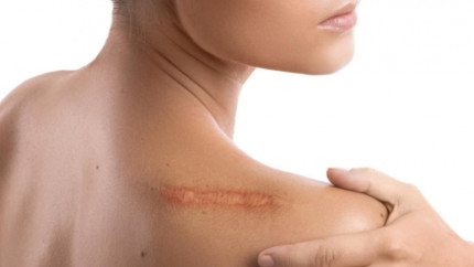 Как восстановить кожу после травмы: метод итальянской пластики