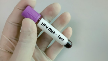 Вирус папилломы человека (ВПЧ). Рак шейки матки