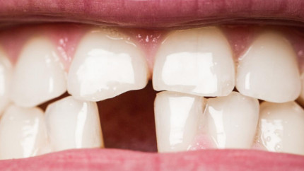 Как избежать потери зубов?