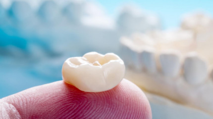 Установка зубных коронок