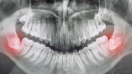 Почему иногда зубы мудрости удаляют еще до их прорезывания?